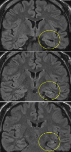 Hippocampal sclerosis2